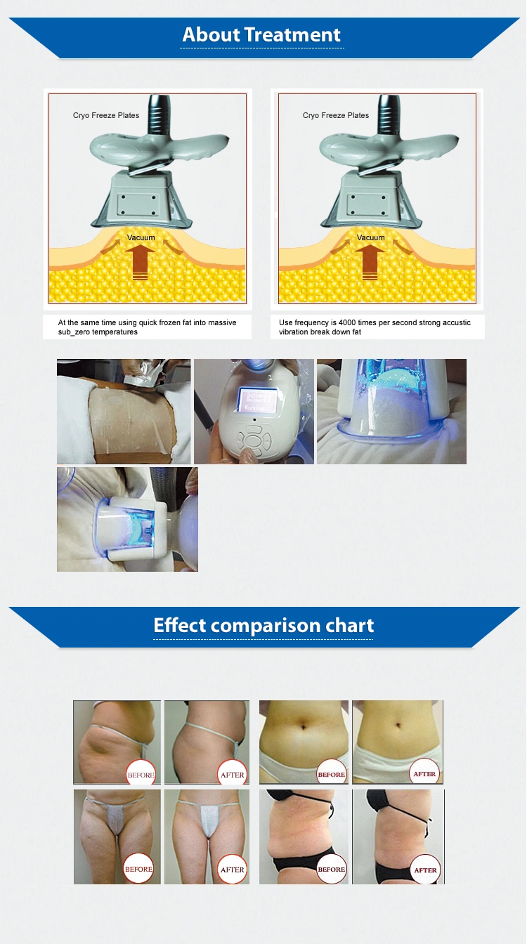 Cool Cryo Criolipolysis Cryolipolisis Criolipolisis Cryolipolysis Slimming Beauty Equipment Machine for Body Shaping